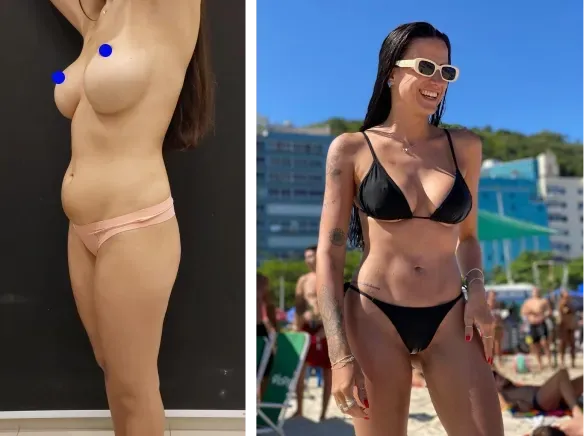 Resultado de abdominoplastia com o Dr. Alexandre Charão no Rio de Janeiro
